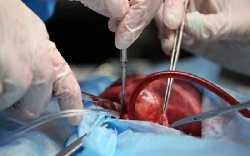 پزشکان زیر بار پیوند عضو اعدامی‌ها نمی‌روند